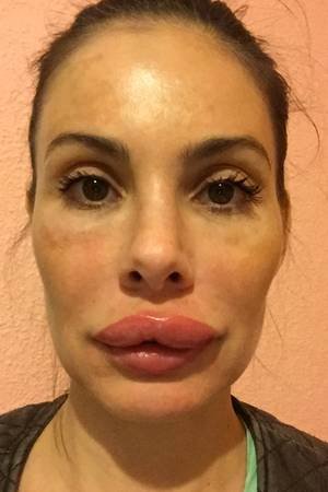 botox.jpg